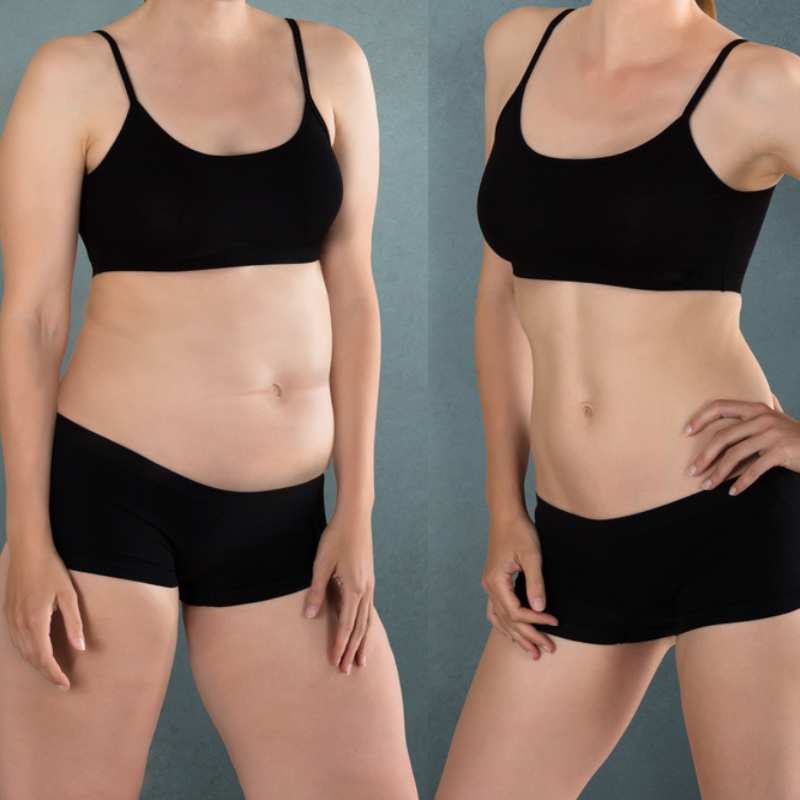 Does Fat Freezing at Home Work? DIY Devices vs Professional Cryolipolysis 2 before and after Cryolipolysis Salford